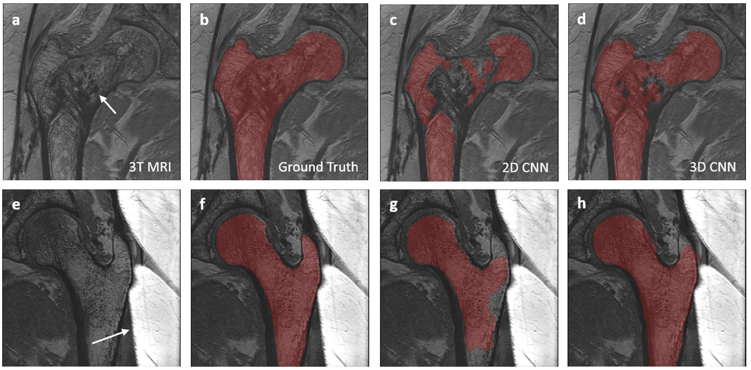 A composite figure illustrating CNN-based segmentation failures on MRI scans of bone marrow. Panels (a) through (d) show a scan with unexpected internal anatomical features; while panel (b) shows the correct "Ground Truth" outline, both the "2D CNN" and "3D CNN" outputs in panels (c) and (d) incorrectly fragment the segmentation around these features. The bottom row demonstrates failures due to image artifacts: panel (e) shows an MRI with significant noise/artifacts outside the bone; while panel (f) is the correct ground truth, both model predictions in panels (g) and (h) fail to maintain proper boundaries.