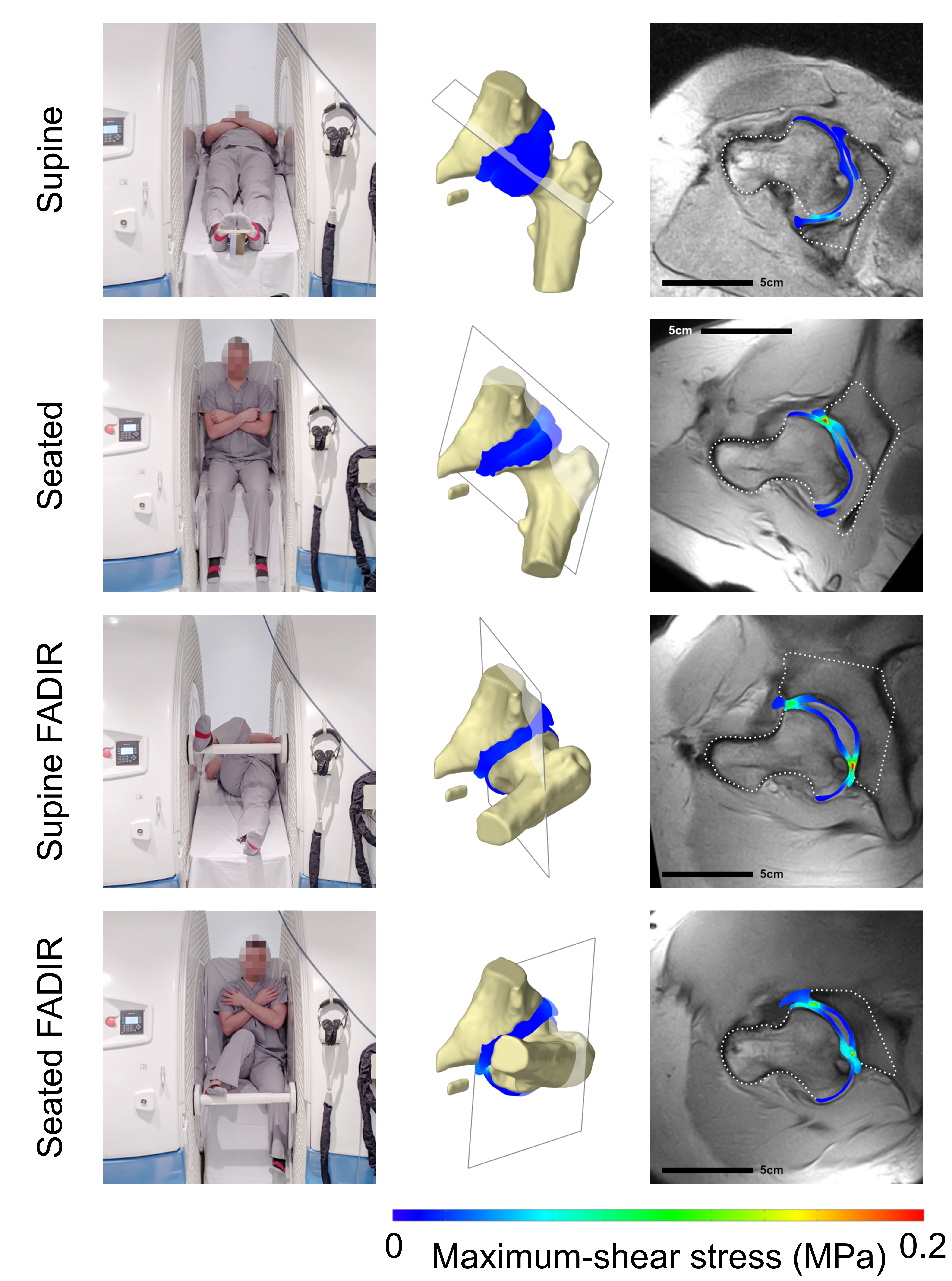 A figure with three columns and four rows. The left column contains photographs of a volunteer demonstrating four different hip positions scanned in an upright open MRI scanner. The middle column shows 3D views of the hip simulation model replicating these poses, and the right column shows the model results overlaid onto MRI scans.