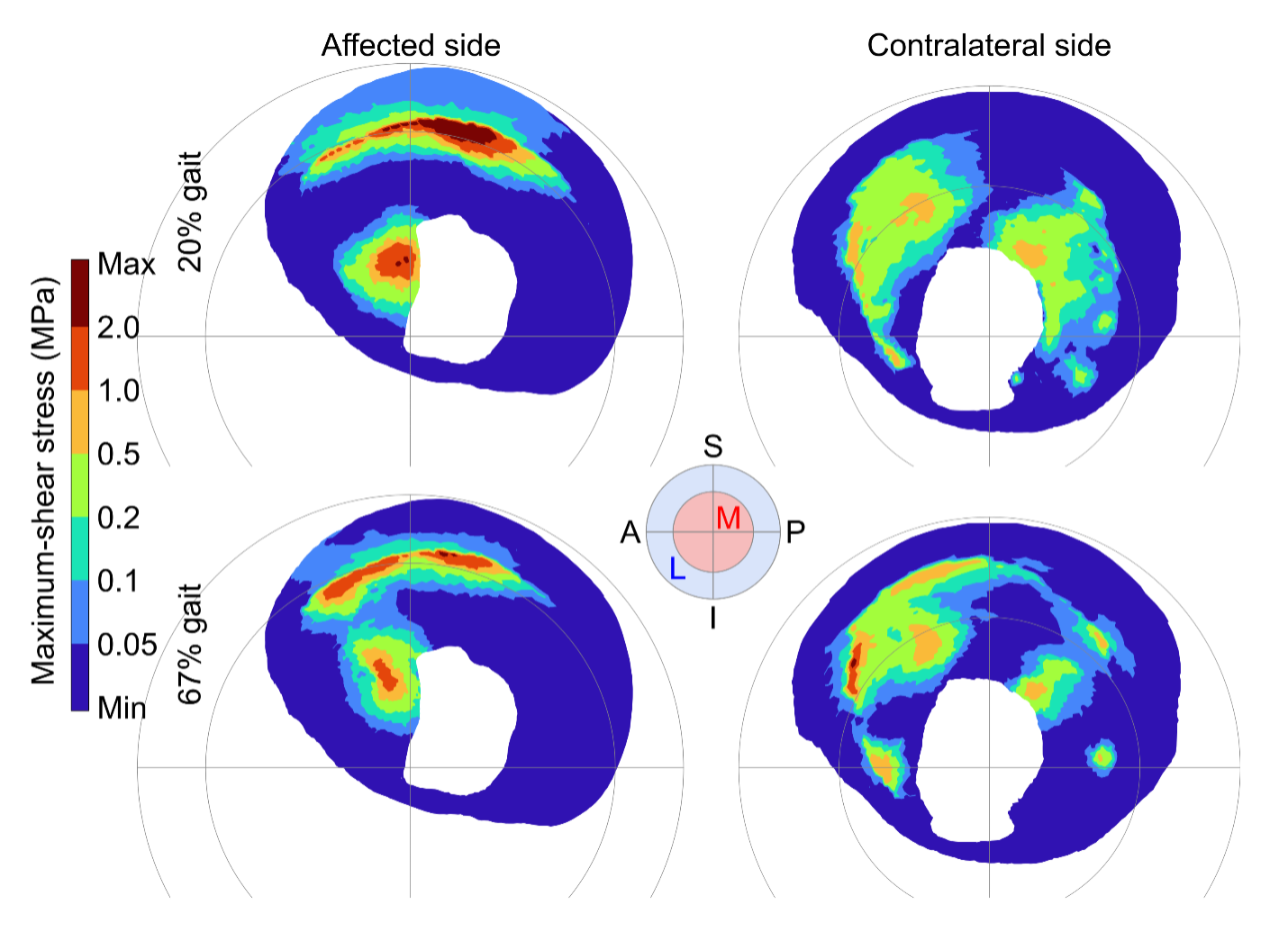 A colourful figure showing stress distribution and the location of stress concentrations in the hip socket.