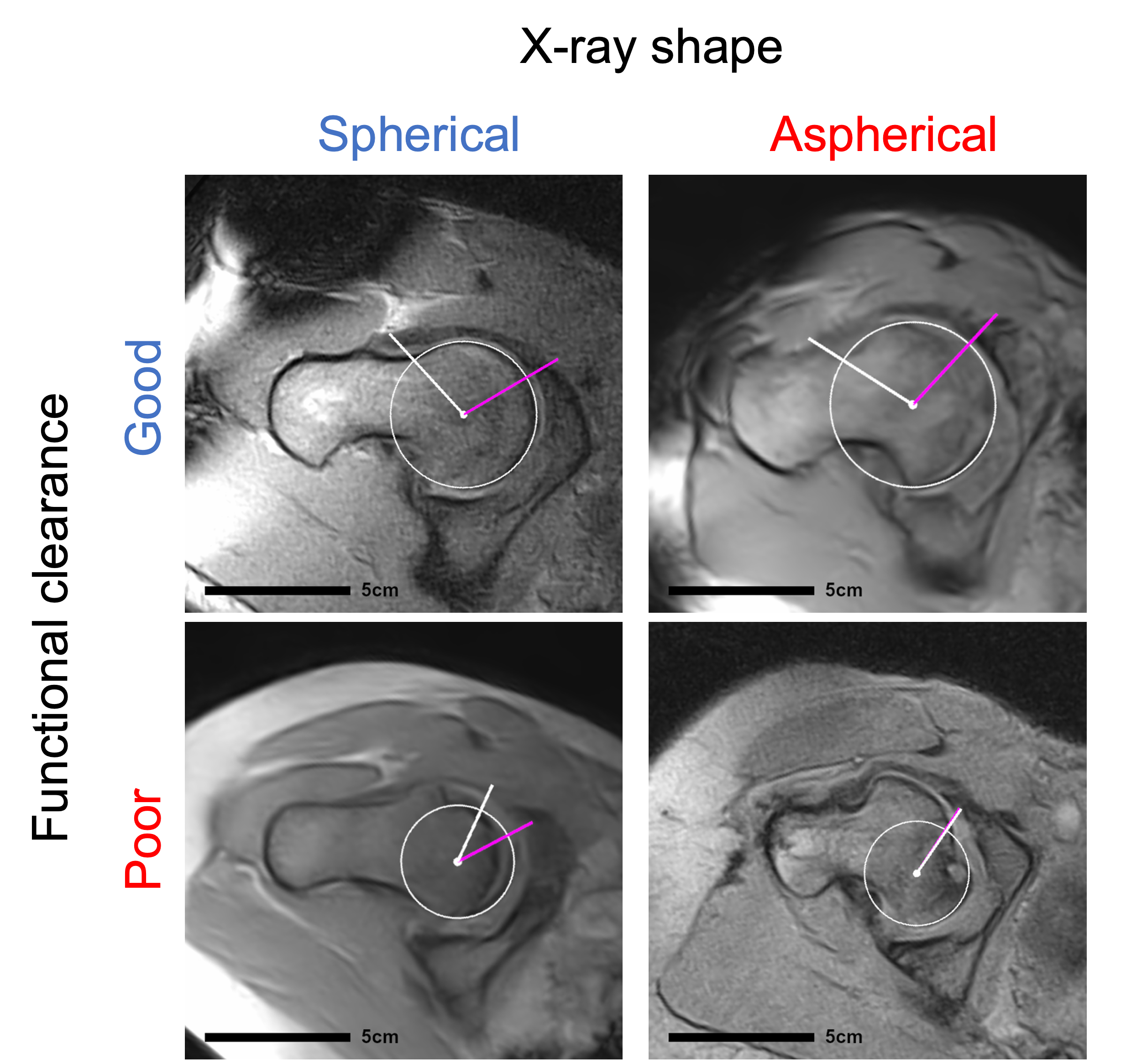 Example MRI slices of four hips, again arranged in a square.