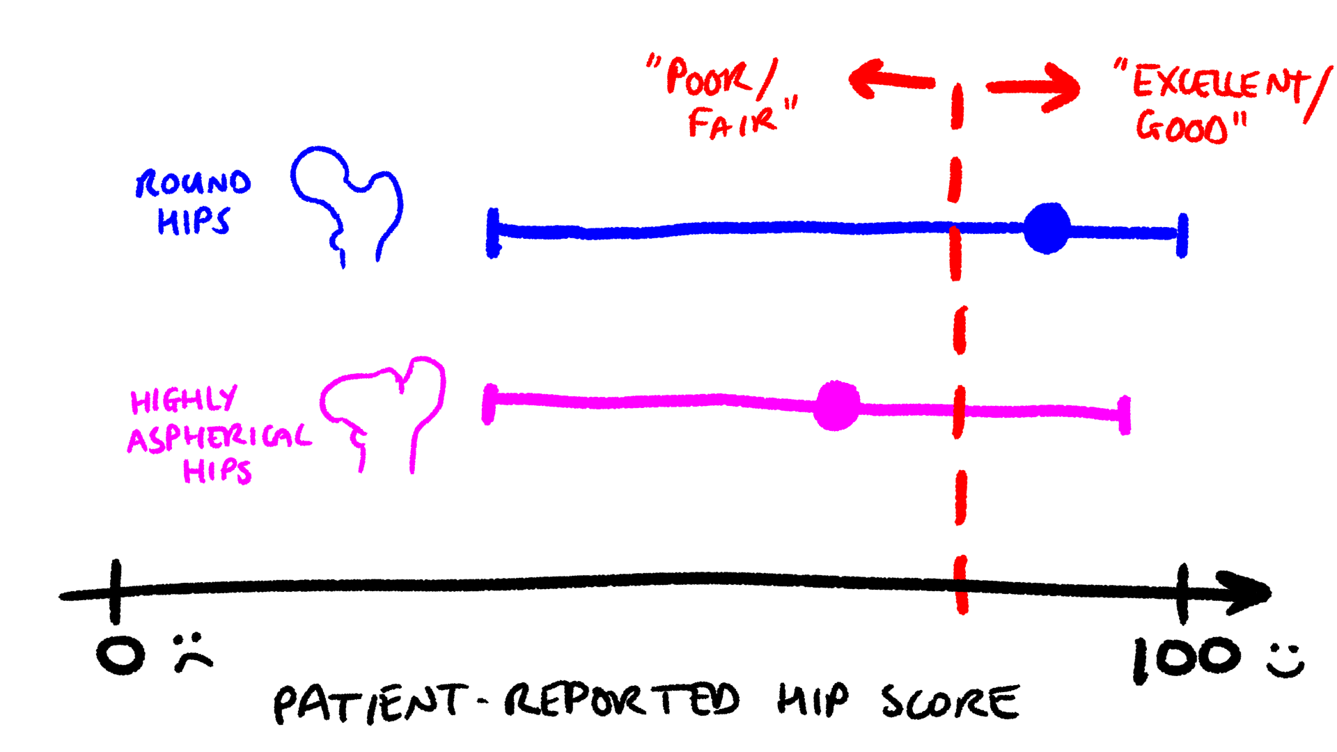 Studies that follow up with people who had Perthes’ disease have shown that patients with highly aspherical hips report lower average outcome scores (round markers) than patients with round hips. However, the range of outcomes (horizontal bars) for each group is almost the same. Sketch based on data from Larson et al. (2012).